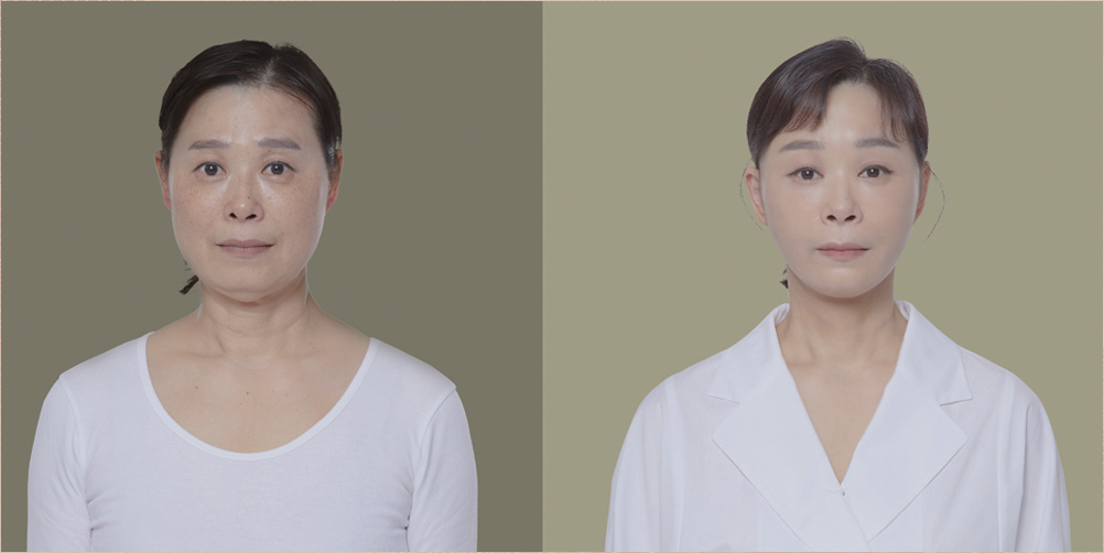 Soonplus before & after photos