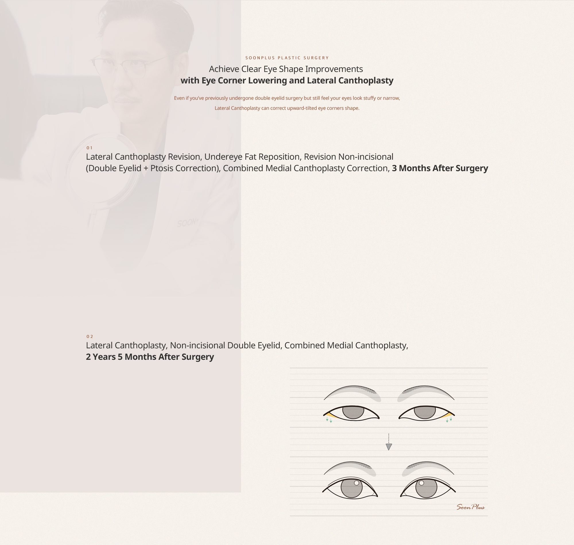 확실한 눈매의 변화를 이끌어내는 눈꼬리내리기/뒤트임
