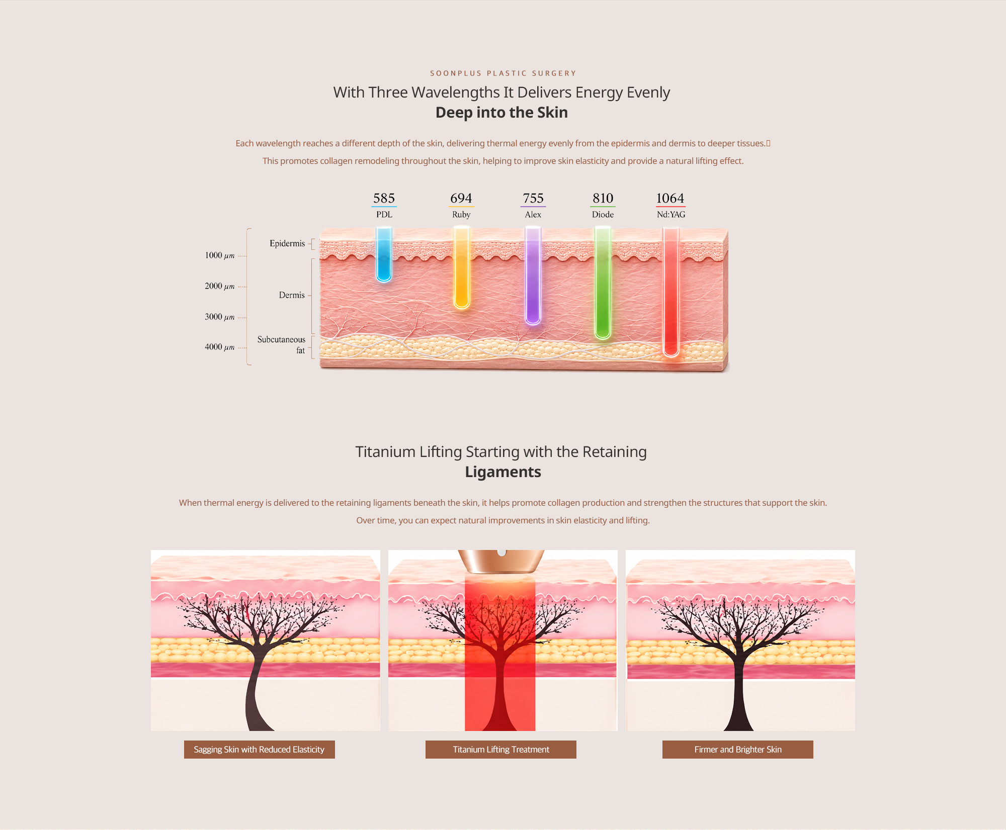 Three wavelengths deliver energy evenly deep into the skin. Titanium Lifting starting with the retaining ligaments: collagen production and skin support.