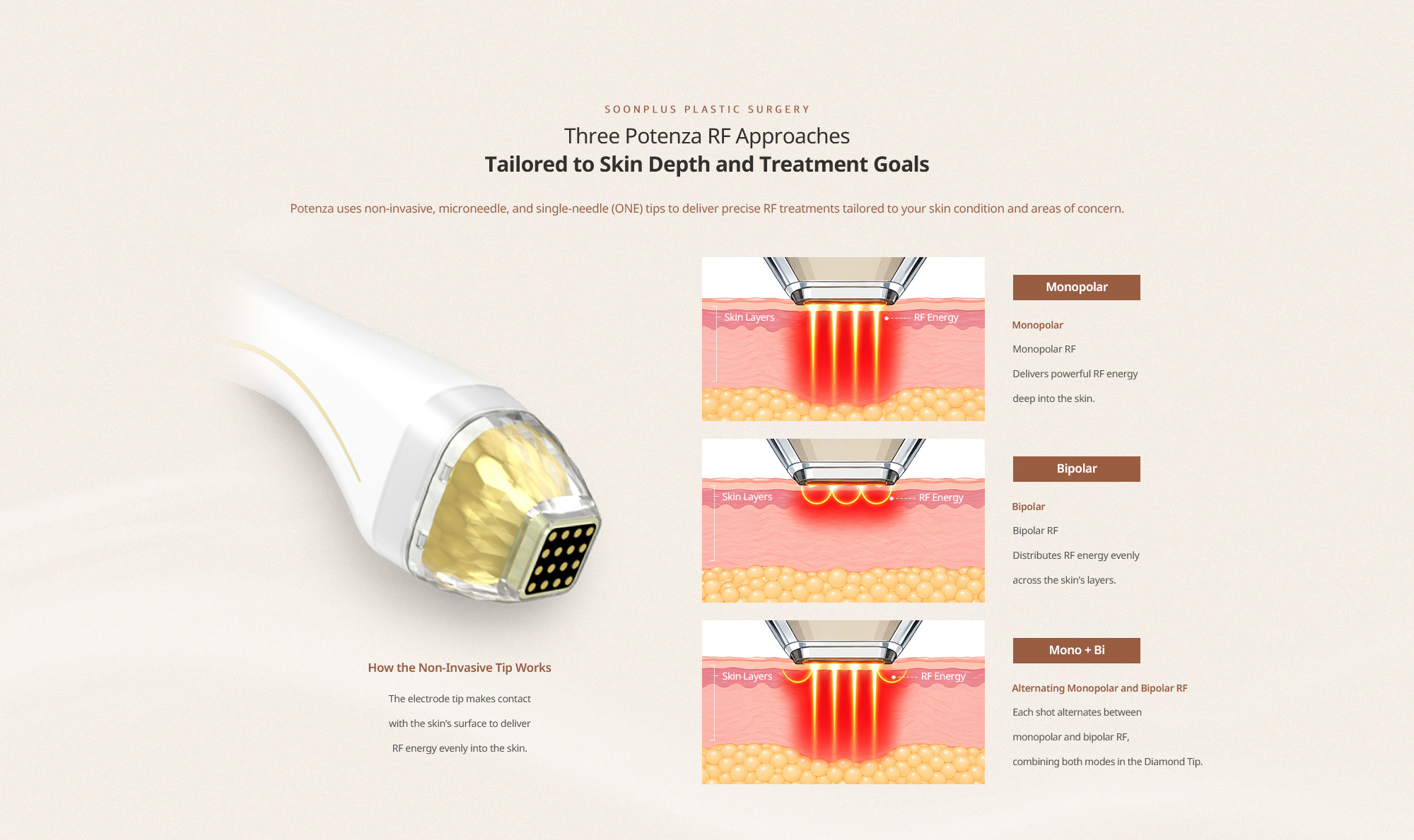 Potenza non-invasive tips: monopolar, bipolar and mono-bipolar RF energy delivery.